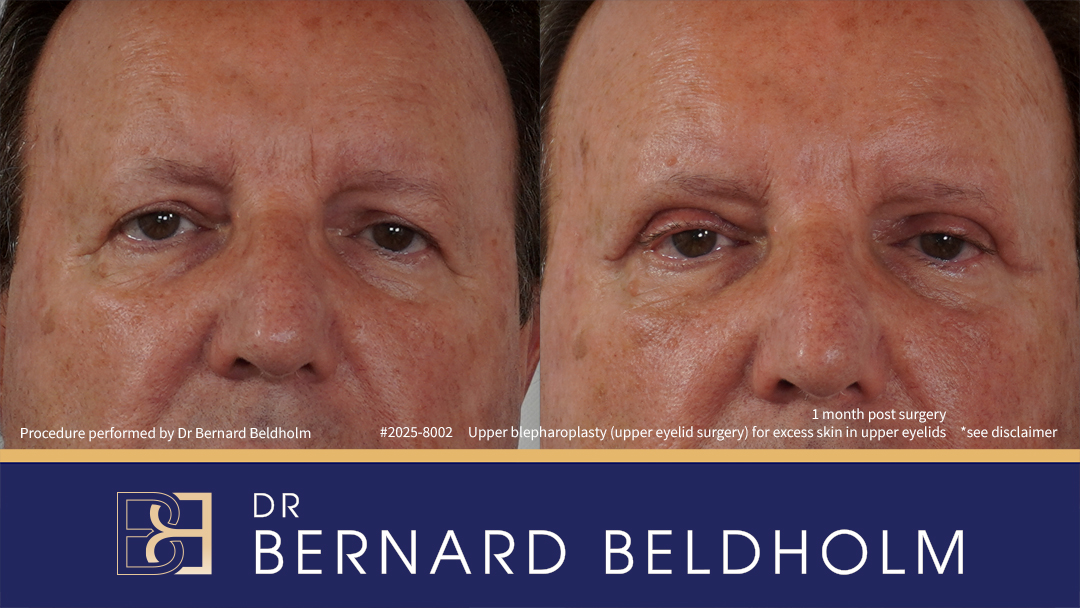 Upper blepharoplasty (upper eyelid surgery) for excess skin in upper eyelids Patient 2025-8002 Upper blepharoplasty (upper eyelid surgery) for excess skin in upper eyelids Patient 2025-8002