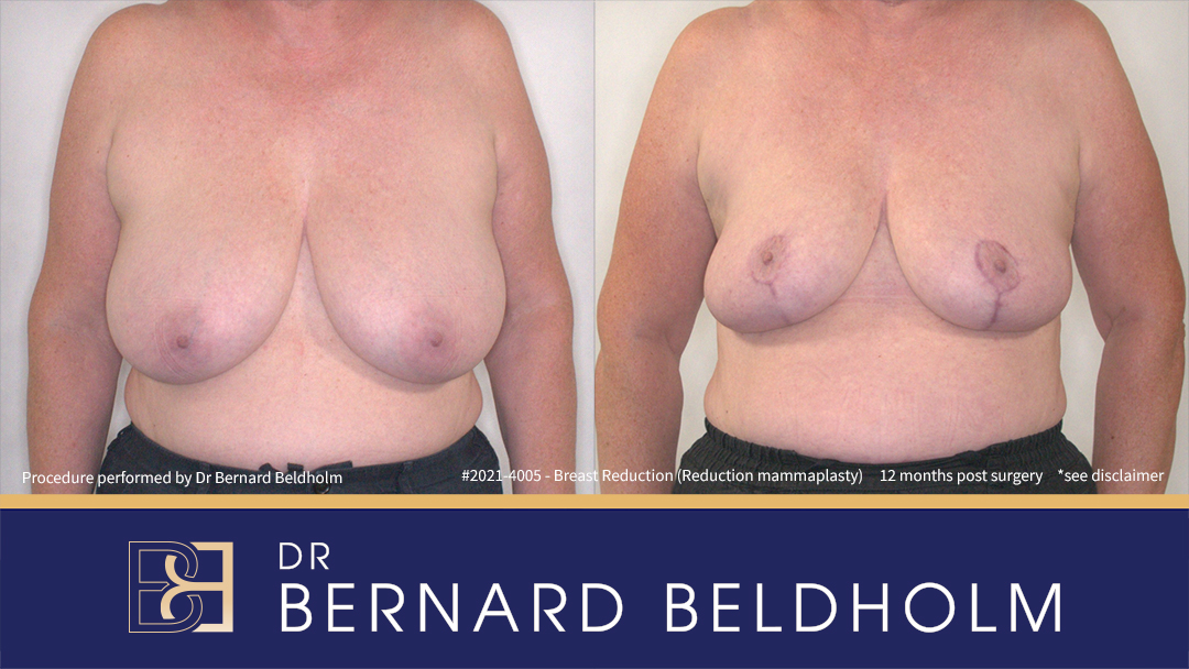 Reduction Mammoplasty (Breast Reduction) Patient 2021-4005 - Front Reduction Mammoplasty (Breast Reduction) Patient 2021-4005 - Front