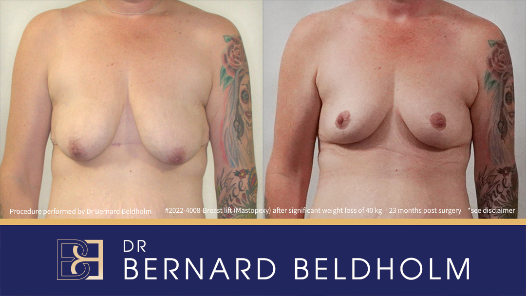 Mastopexy (Breast Lift) Patient 2022-4008 - Front Mastopexy (Breast Lift) Patient 2022-4008 - Front