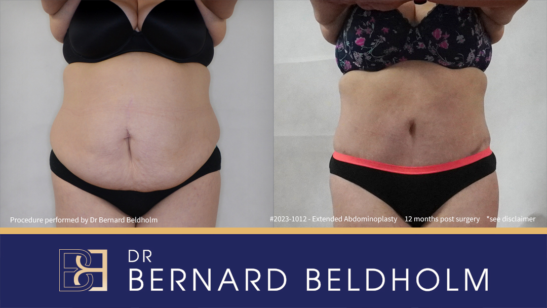 Abdominoplasty Post Weight Loss and Post Pregnancy, Including Repair of Diastasis Recti and VASER liposuction (Patient 2023-1012) - Front Abdominoplasty Post Weight Loss and Post Pregnancy, Including Repair of Diastasis Recti and VASER liposuction (Patient 2023-1012) - Front