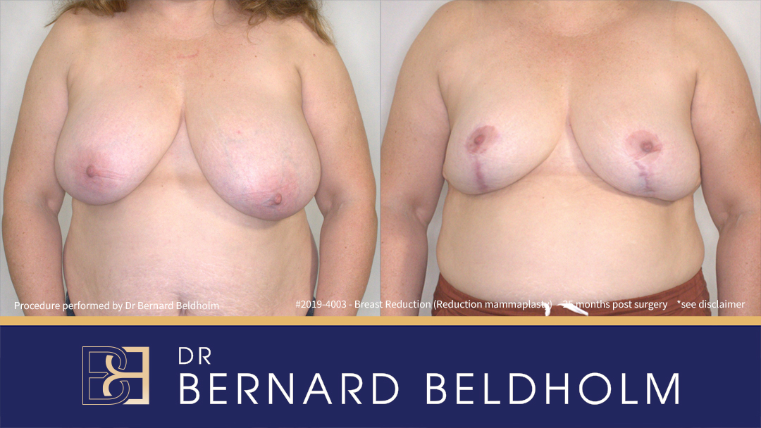 Breast Reduction (Reduction Mammoplasty) for F Cup (Patient 2019-4003) - Front Breast Reduction (Reduction Mammoplasty) for F Cup (Patient 2019-4003) - Front