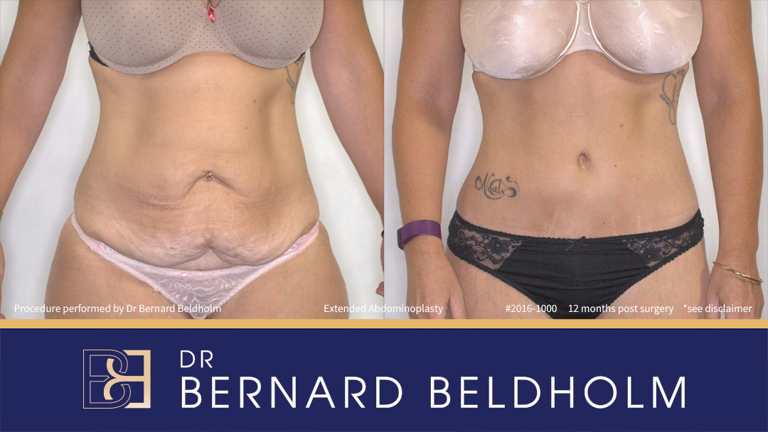 Patient 2016-1000 - Abdominoplasty Post Weight Loss Extended Abdominoplasty (Tummy Tuck) After 50kg of Weight Loss (Patient 2016-1000) - Front