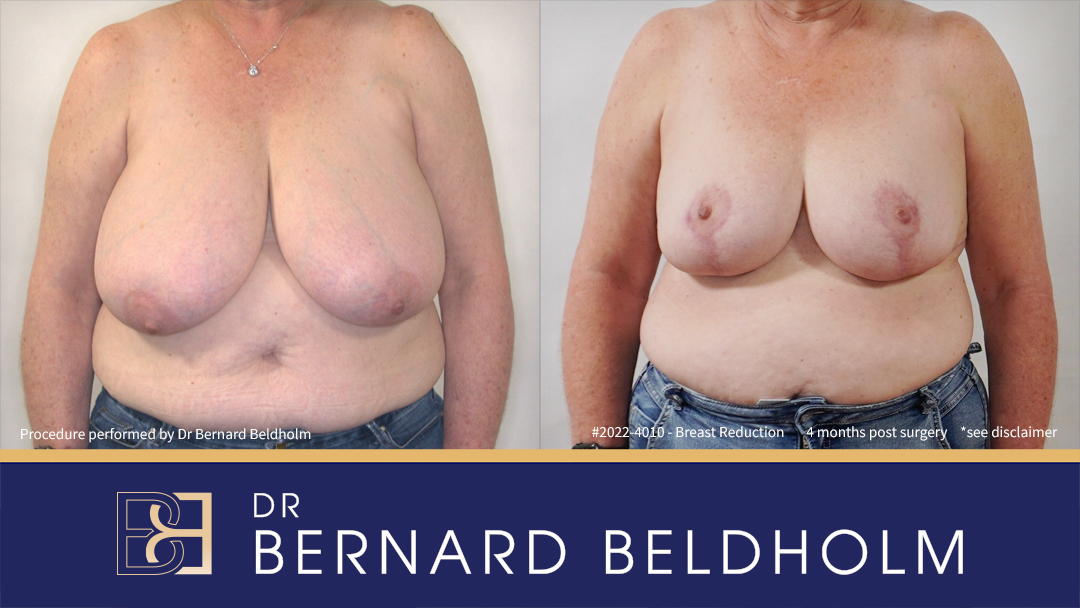 Breast Reduction (Reduction Mammoplasty) for G Cup Uneven Breasts (Patient 2022-4010) Breast Reduction (Reduction Mammoplasty) for G Cup Uneven Breasts (Patient 2022-4010)