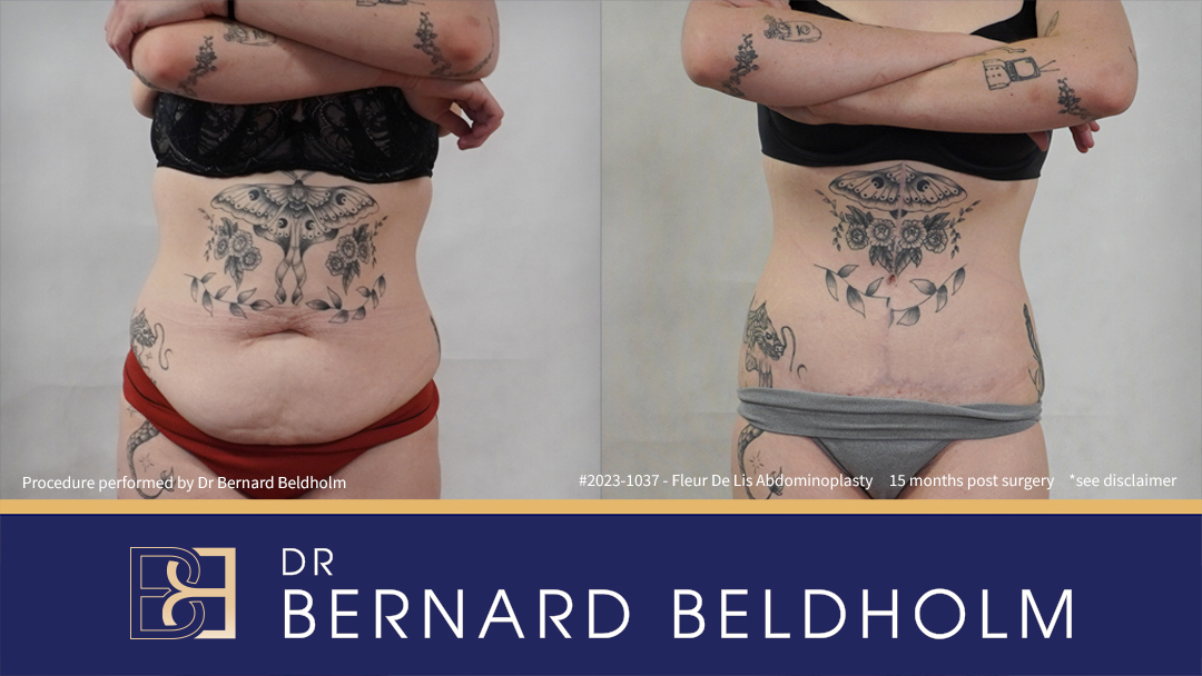 Fleur de Lis Abdominoplasty After Loosing 50kg of Weight (Patient 2023-1037) Fleur de Lis Abdominoplasty After Loosing 50kg of Weight (Patient 2023-1037) - Front