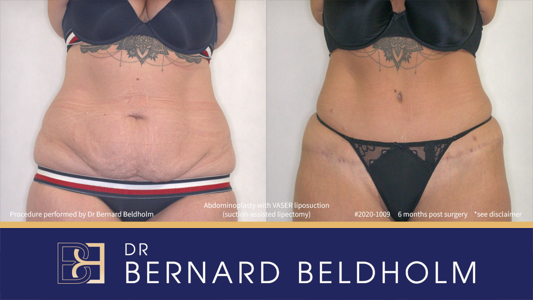 Abdominoplasty with VASER Liposuction (Suction-assisted Lipectomy) (Patient 2020-1009) Abdominoplasty with VASER Liposuction (Suction-assisted Lipectomy) (Patient 2020-1009)