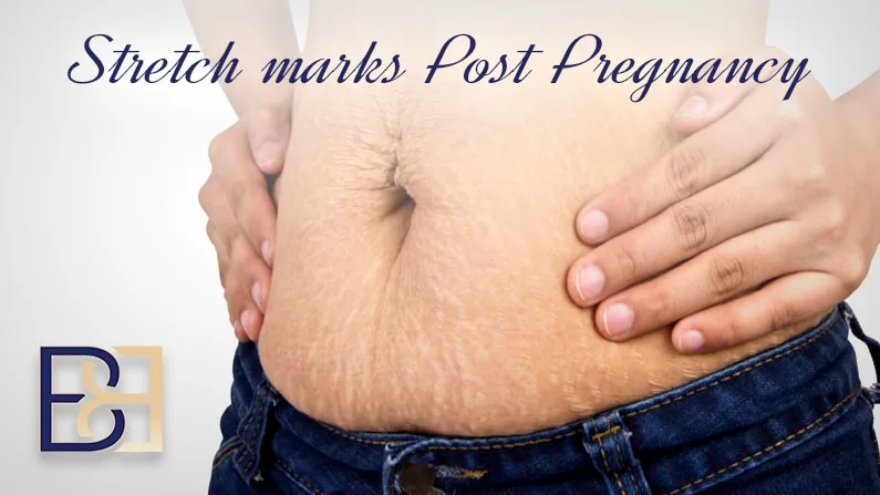 11 Proven Ways to Prevent and Treat Stretch Marks During Pregnancy