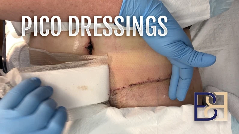 Improve Abdominoplasty Scars with PICO Negative Pressure Dressings