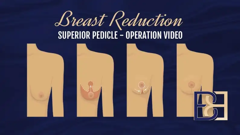 Operation Guide: Intra-op Breast Reduction with Lipo