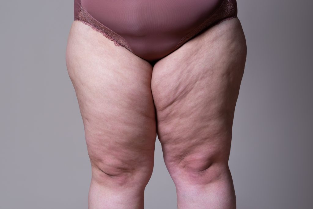 Medial Thighplasty (Inner Thigh Lift) After Weight Loss Surgery 5 Obese female thighs