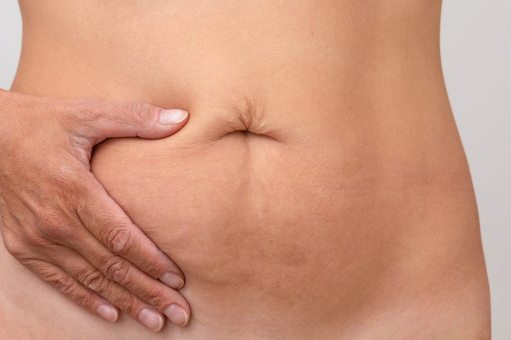 Dr Bernard Beldholm's Guide to Revision Abdominoplasty (Tummy Tuck) Surgery 5 Belly button revision