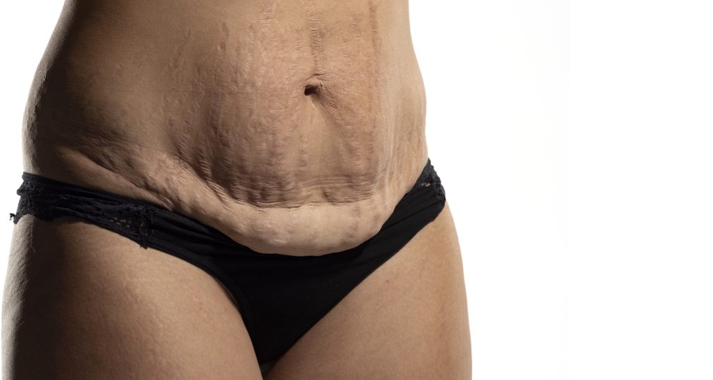 Dr Bernard Beldholm's Guide to Revision Abdominoplasty (Tummy Tuck) Surgery 2 Woman with loose skin and stretch marks on her belly after pregnancy. Close up