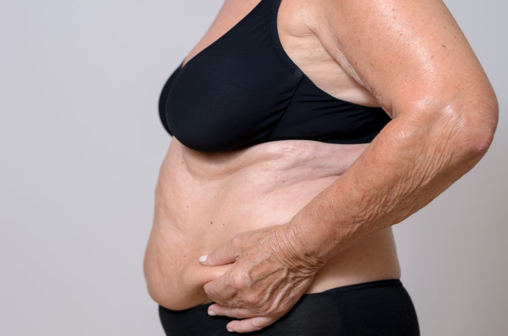 Dr Bernard Beldholm's Guide to Revision Abdominoplasty (Tummy Tuck) Surgery 1 iStock 481087202