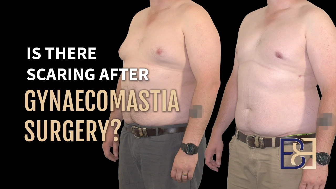 This is What Gynaecomastia Scars Really Look Like
