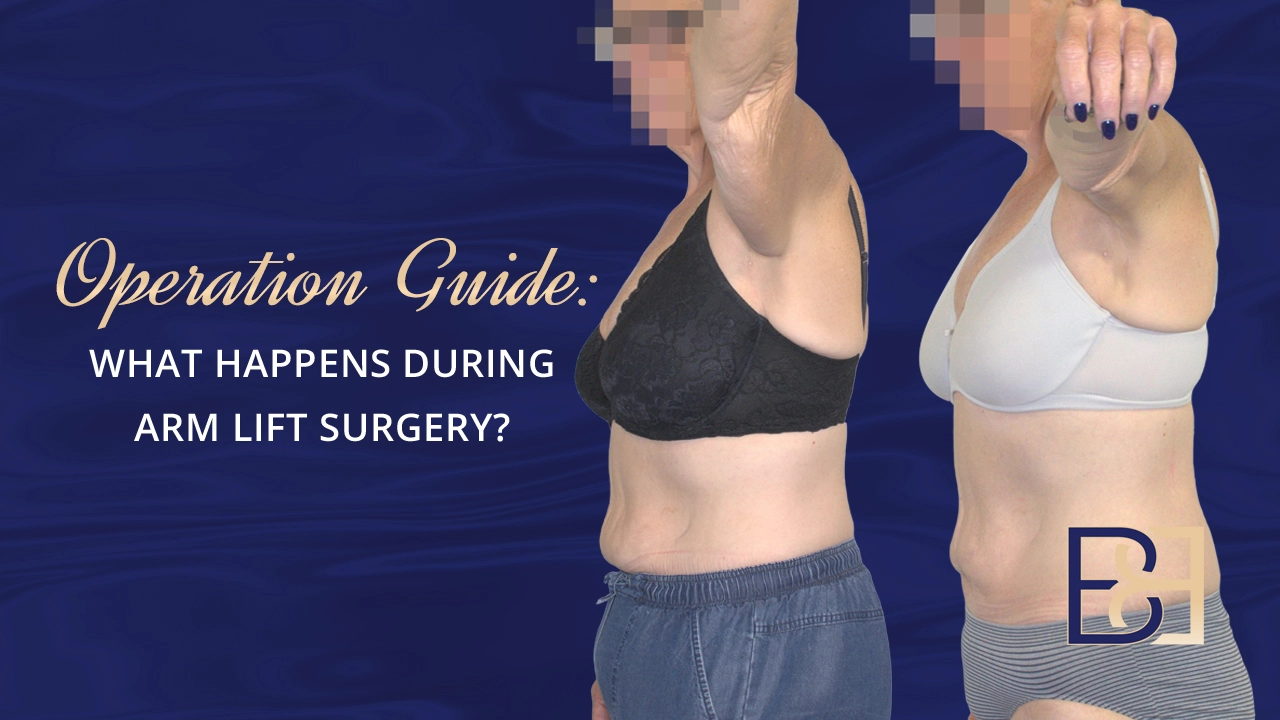 Operation Guide - What Happens During Arm Lift Surgery