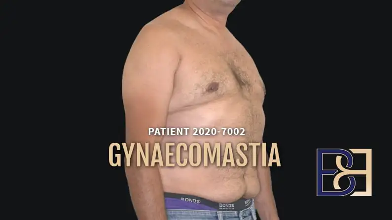 Operation Guide: Gynaecomastia Surgery with VASER Liposuction