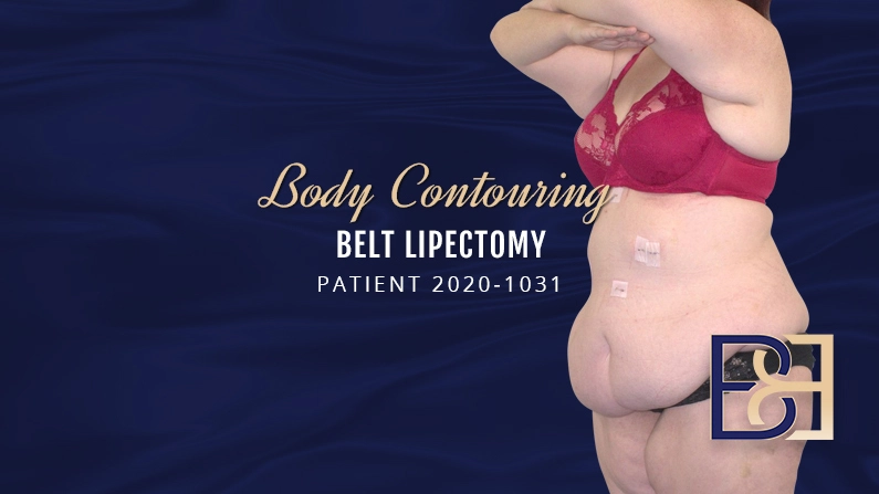 Patient 2020-1031 Belt Lipectomy Body Contouring