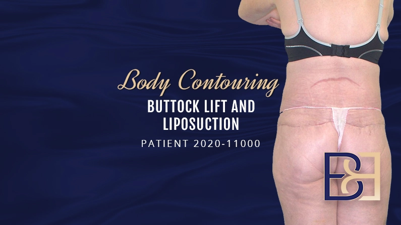 2020-11000 Buttock lift and Liposuction - Body Contouring