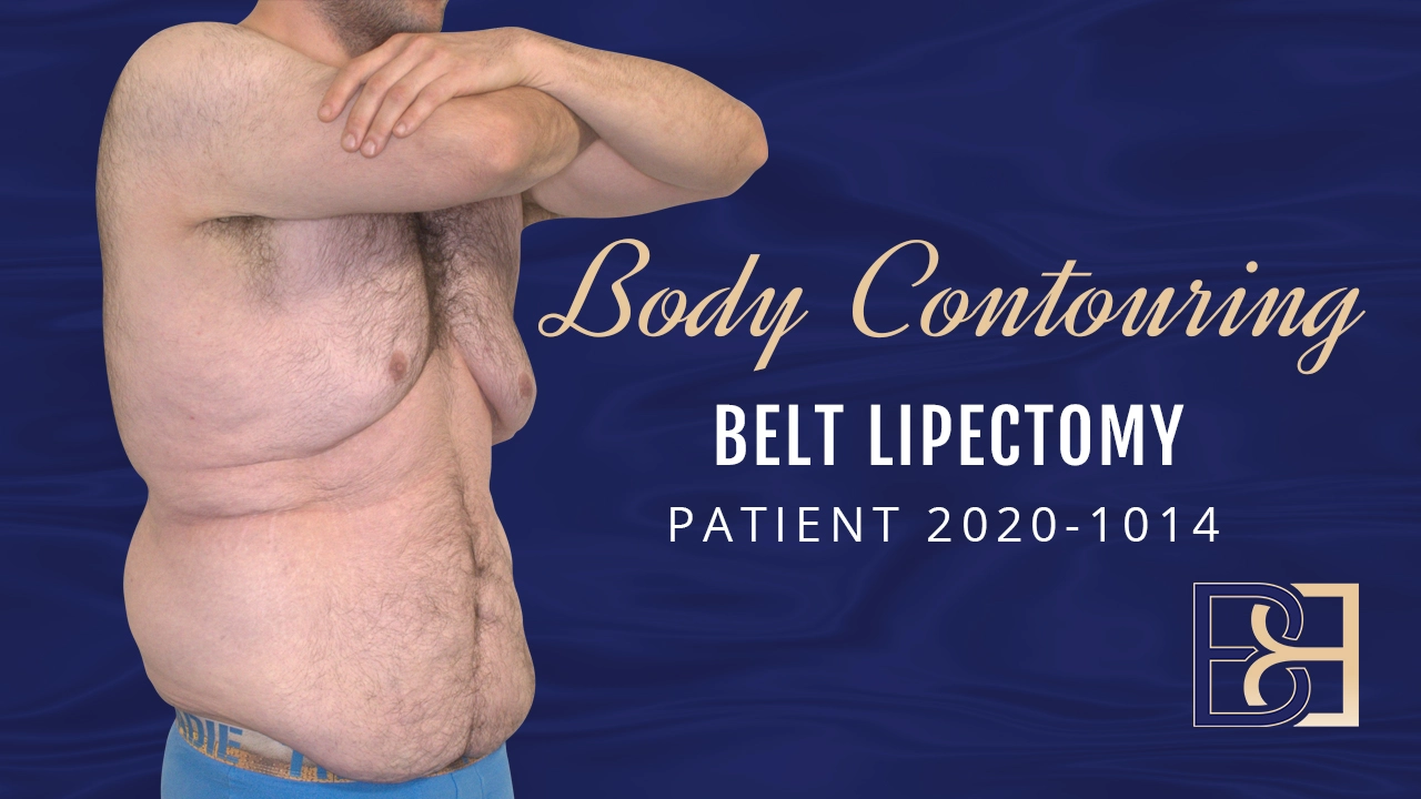 Patient 2020-1014 Belt Lipectomy - Body Contouring