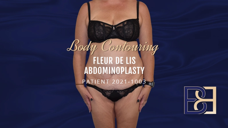 Patient 2021-1003 - Body Contouring - Fleur de lis Abdominoplasty