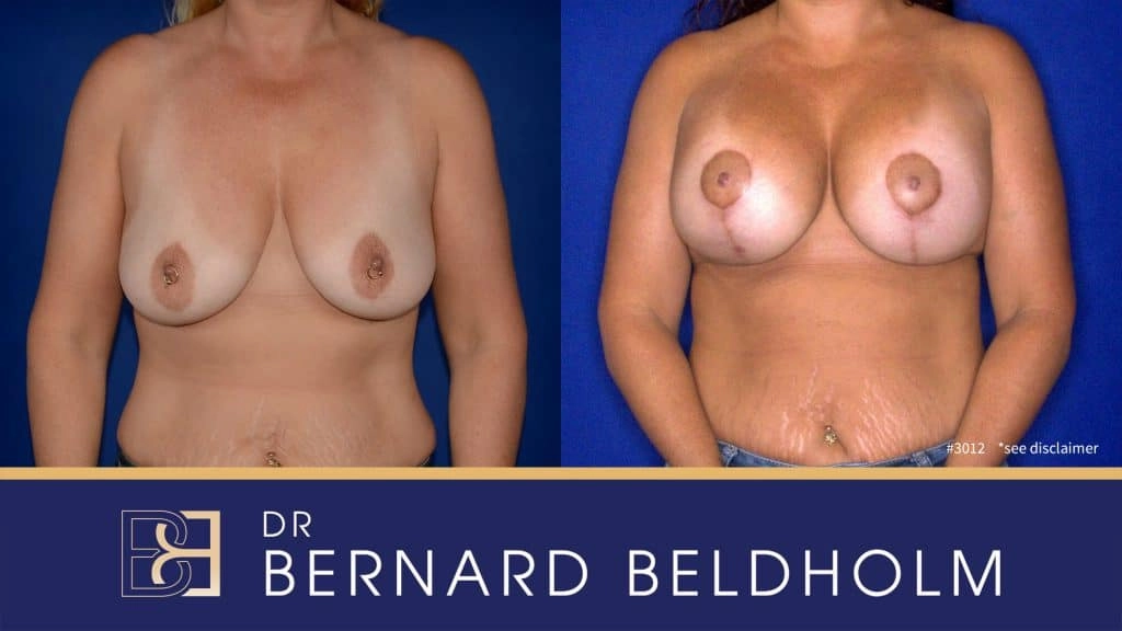 Patient 3012 - Breast Augmentation and Lift