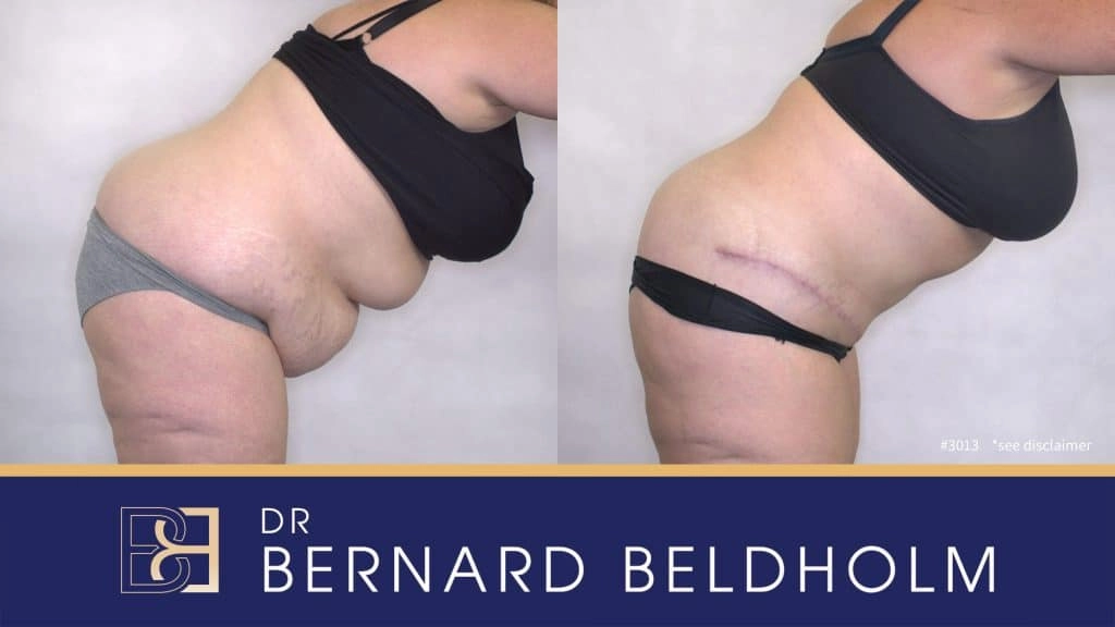Patient 3013 - Tummy Tuck - Side