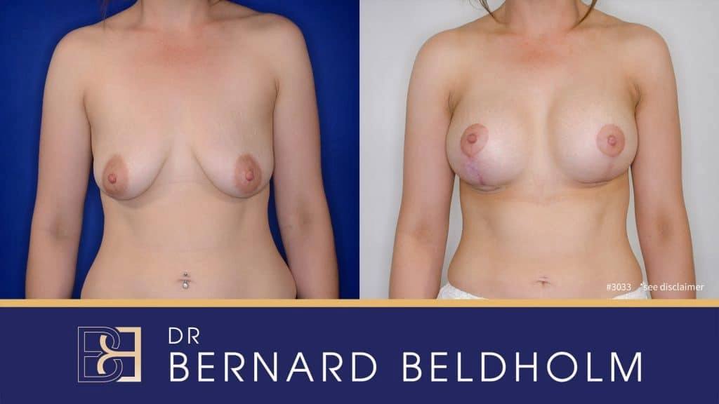 Patient 3033 - Breast Augmentation and Lift