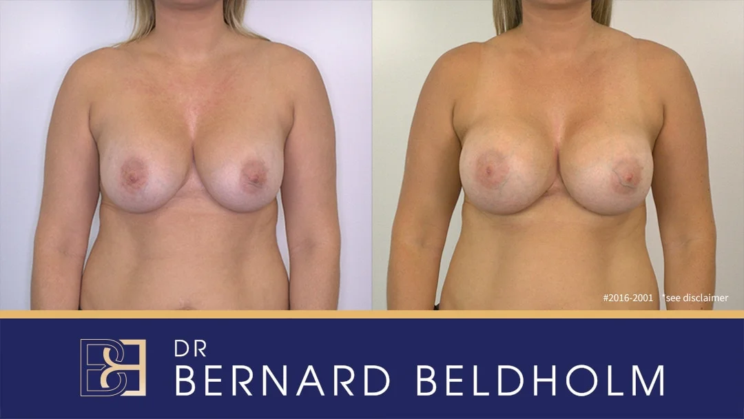 Patient 2016-2001 - Removal and Replacement of Breast Implants