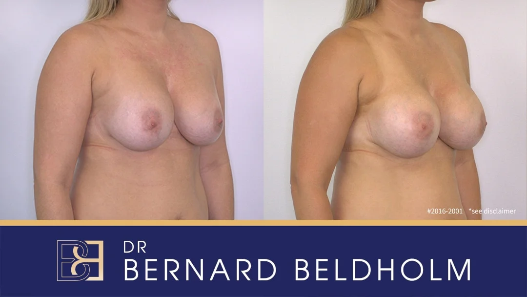 Patient 2016-2001 - Removal and Replacement of Breast Implants