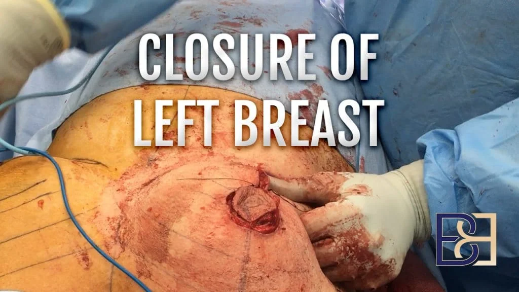 Patient 2016-4000 - Breast Reduction - Closure of Left Breast