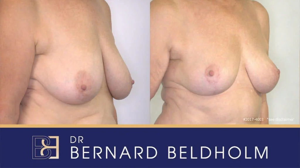 Patient 2017-4003 - Breast Reduction - Before & After