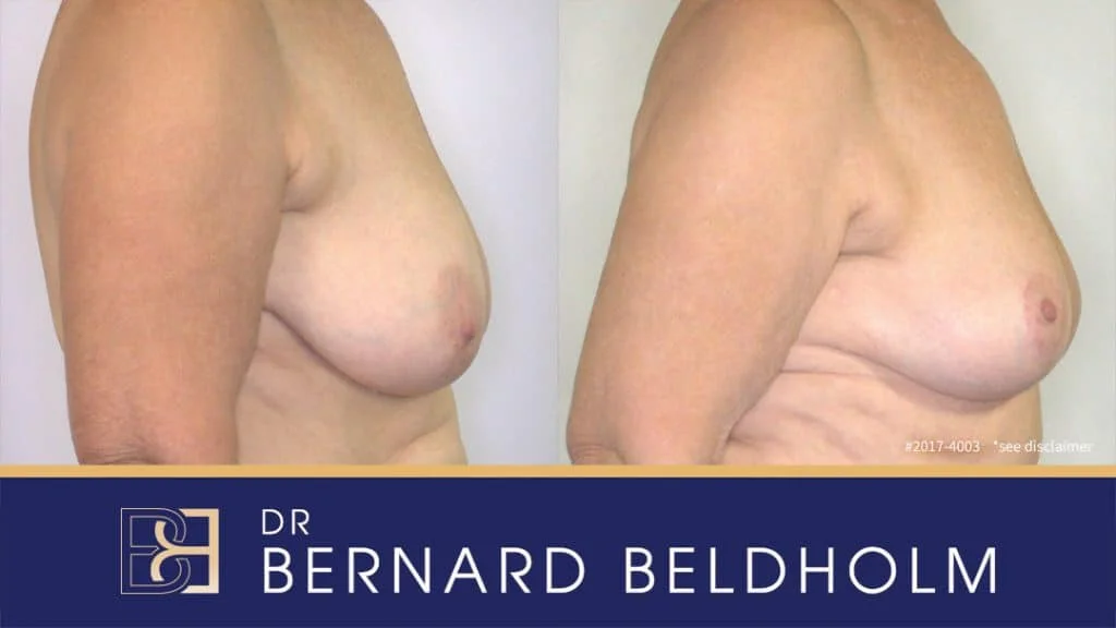 Patient 2017-4003 - Breast Reduction - Before & After