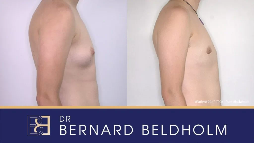 Patient 2017-7000 - Transgender Female to Male - Subcutaneous Mastectomy