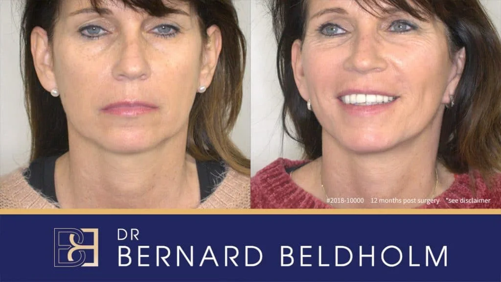 Patient 2018-10000 - Full Face Lift with Neck Plication - Before & After