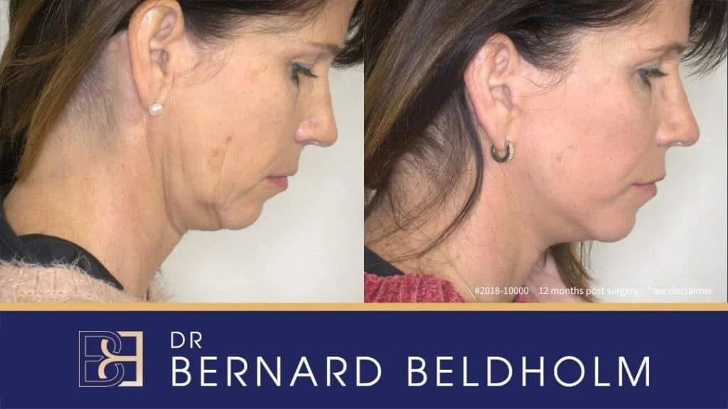 Patient 2018-10000 Full Face Lift with Neck Plication - Before & After