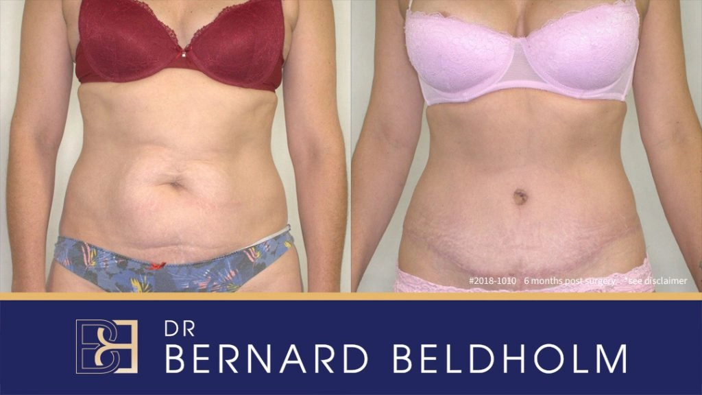Patient 2018-1010 - Tummy Tuck - Breast Reduction - Before & After