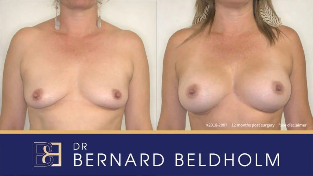 Patient 2018-2007 - Breast Augmentation - Before & After