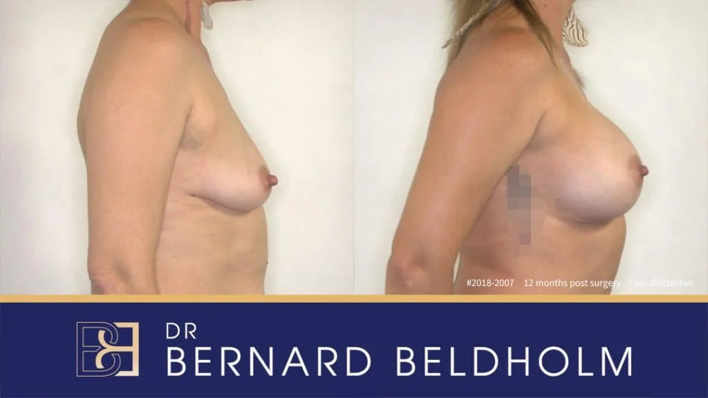 Patient 2018-2007 - Breast Augmentation - Before & After