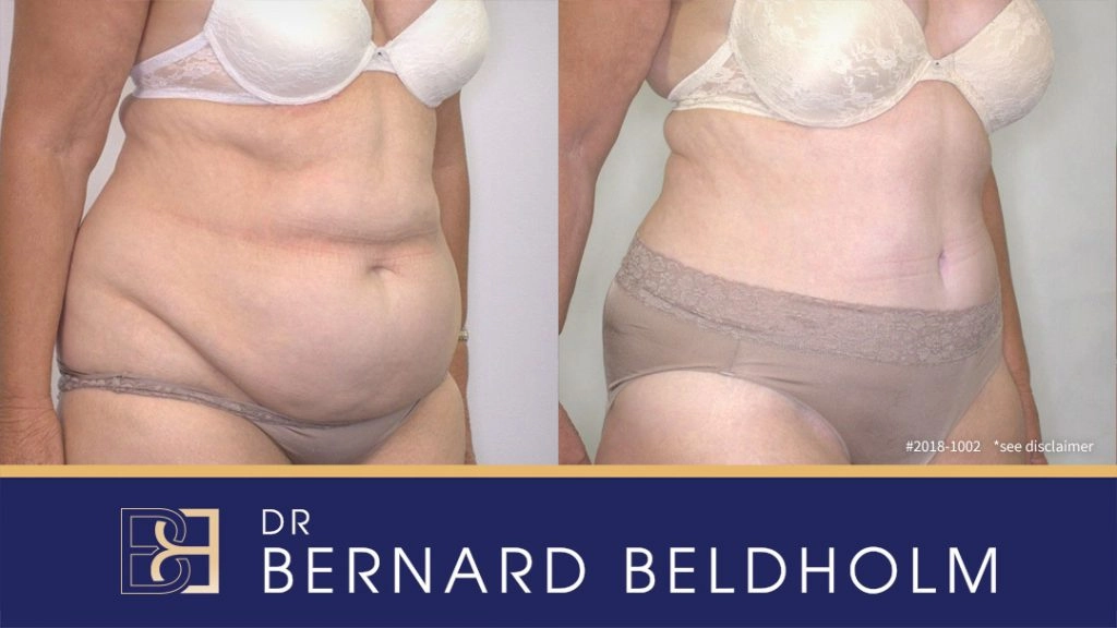 Patient 2018-1002 - Tummy Tuck - Before & After