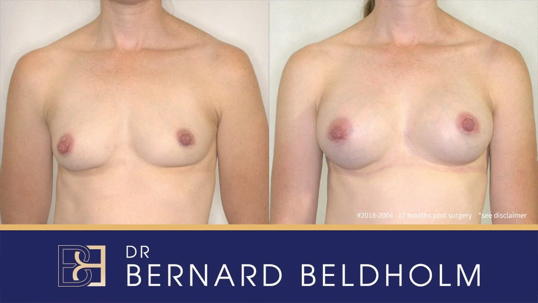 Patient 2018-2004 - Breast Augmentation - Before & After