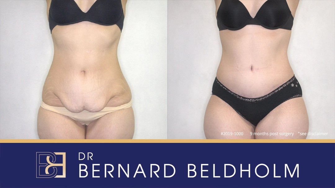 Patient 2019-1000 Abdominoplasty - Before & After