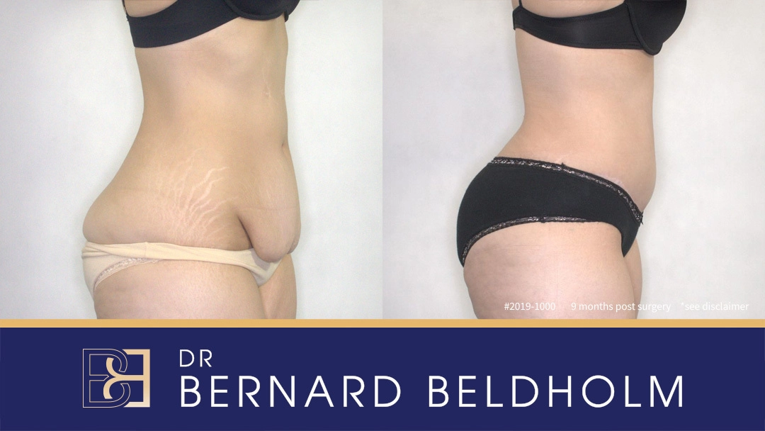 Patient 2019-1000 Abdominoplasty - Before & After