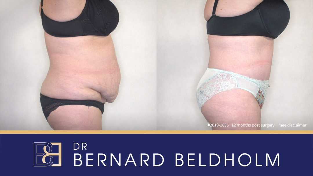 Patient 2019-1005 - Abdominoplasty - Before & After