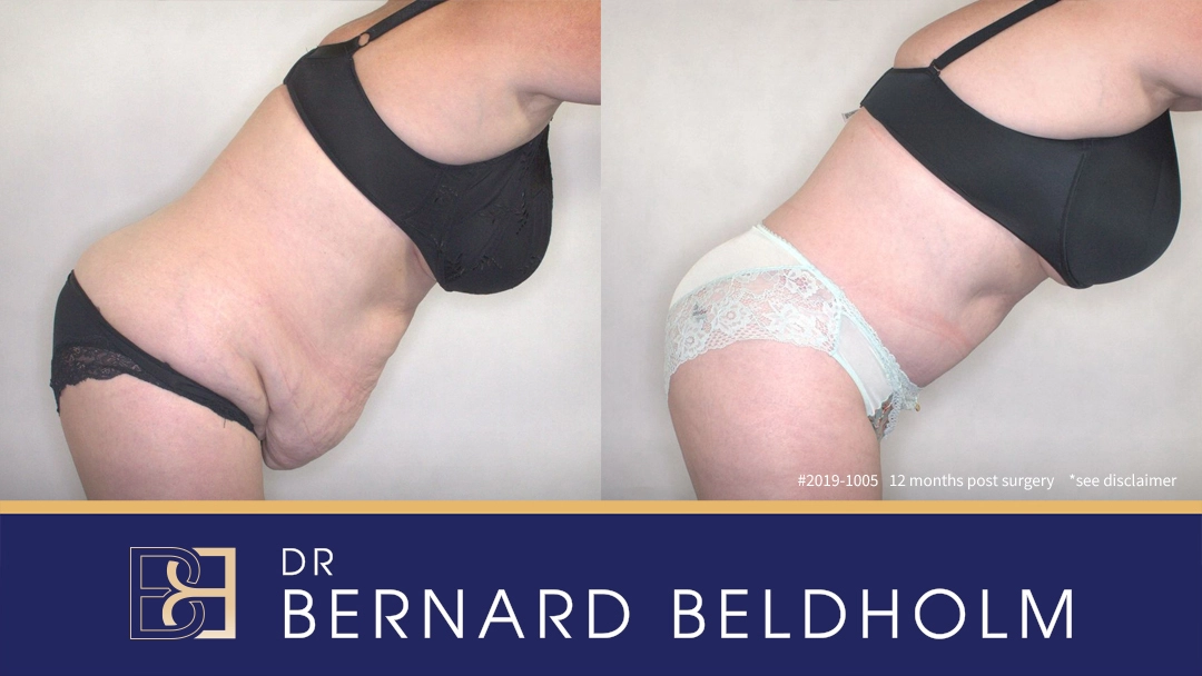 Patient 2019-1005 - Abdominoplasty - Before & After