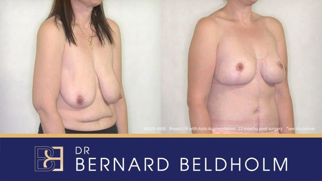 Patient 2020-4008 - Breast Lift - Before & After