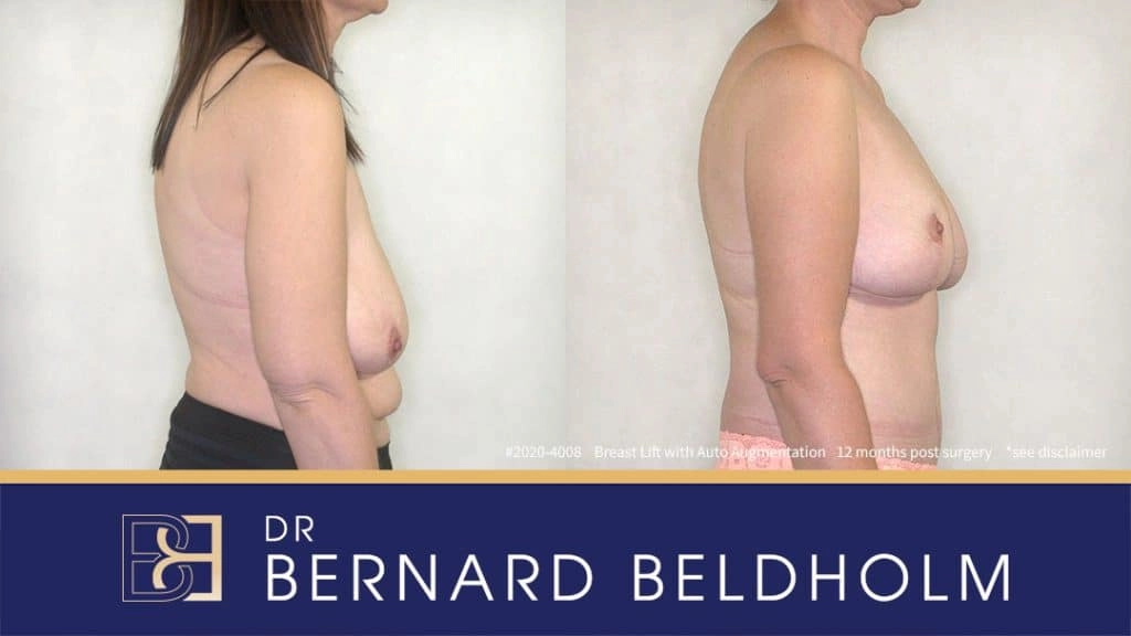Patient 2020-4008 - Breast Lift - Before & After