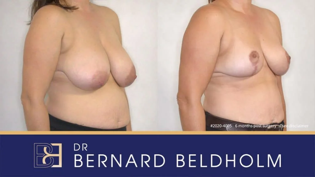 Patient 2020 - 4005 - Breast Reduction - Before & After