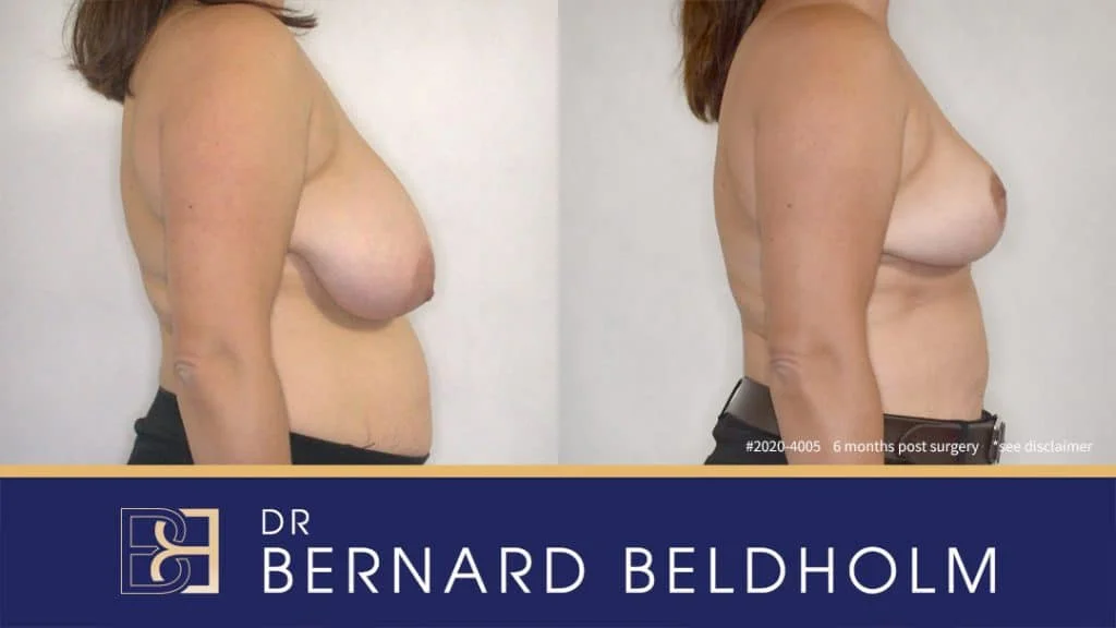 Patient 2020-4005 - Breast Reduction - Before & After