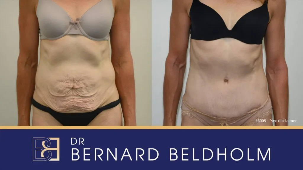 Patient 3005 - Before & After Abdominoplasty