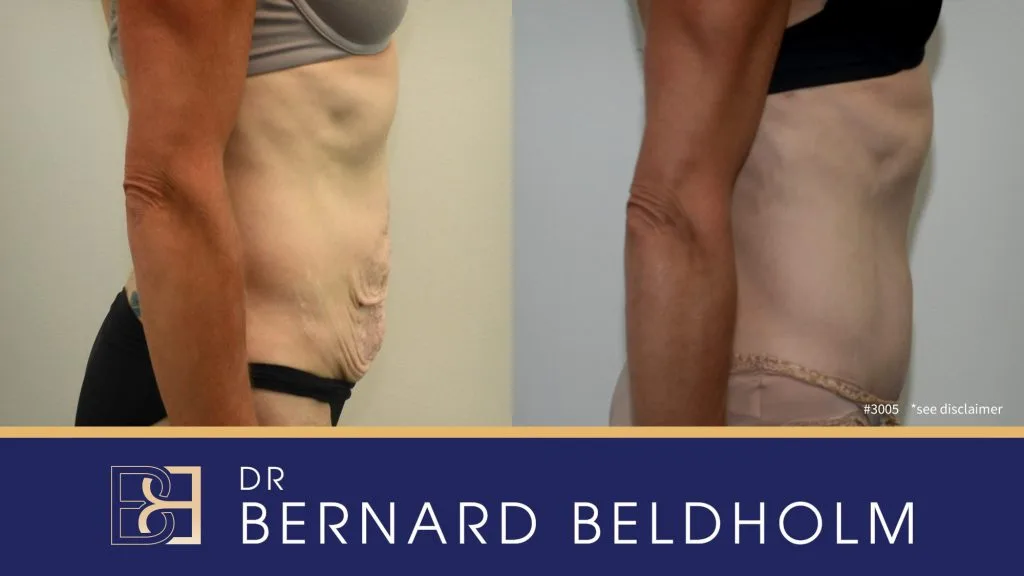Patient 3005 - Before & After Abdominoplasty