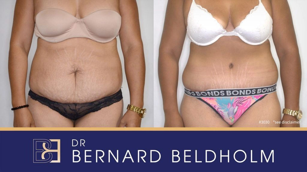 Patient 3030 Before & After - Abdominoplasty